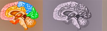 Three types of ischemic strokes