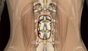 a surgical incision shown in 3D on a human back exposing the internal anatomical structures affected by back surgery