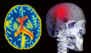 Magnetic Resonance Image MRI of the human brain after a stroke with an indication of the region as illustrated on a human skeletan