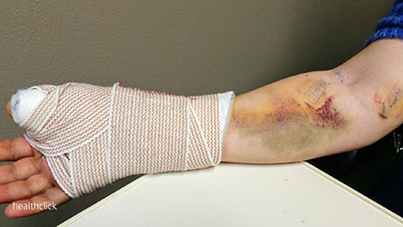 Wound Care